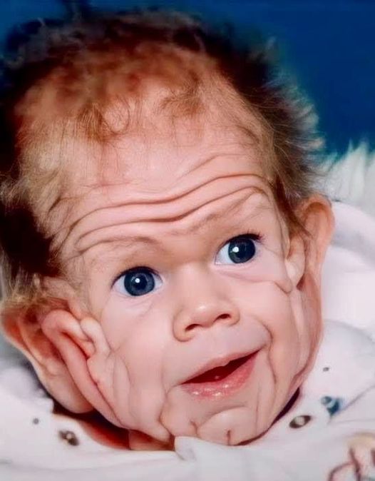 In 1993, This Boy Was Born With Enough Skin For A Five-Year-Old